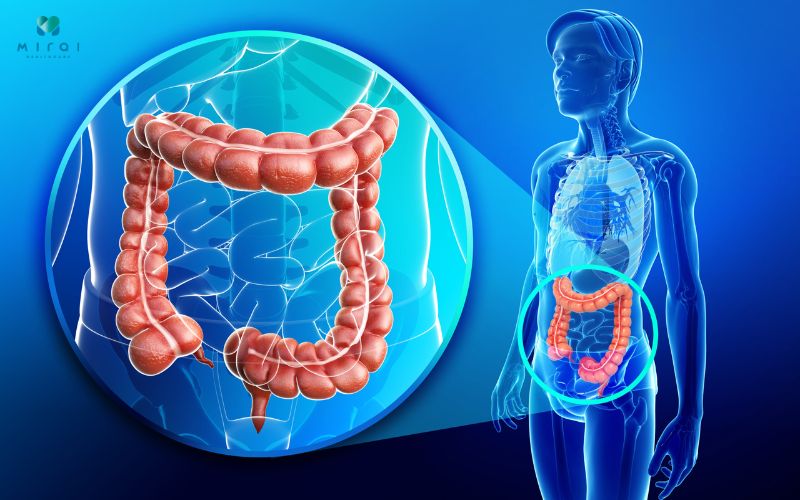 Ung thư giai đoạn 2 là đã phát triển vào sâu thành trực tràng