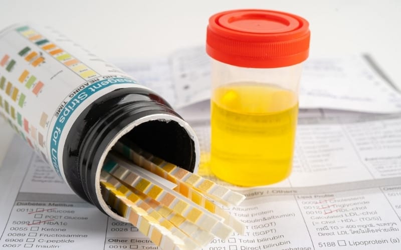 Xét nghiệm protein niệu là đo lượng protein trong nước tiểu