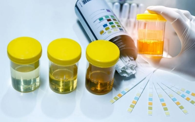 Xét nghiệm protein niệu âm tính - chức năng thận bình thường