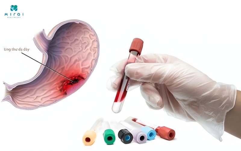 Xét nghiệm máu giúp phát hiện ung thư dạ dày sớm
