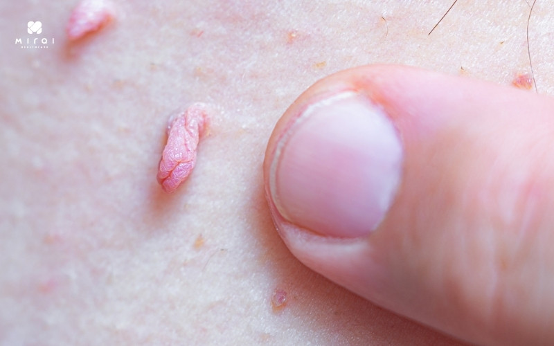 Sự xuất hiện của các nốt sùi, u nhú cảnh báo sùi mào gà