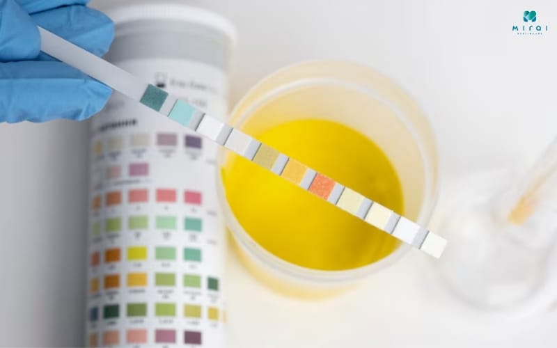 Chỉ số Albumin nước tiểu giúp đánh giá tổn thương của thận