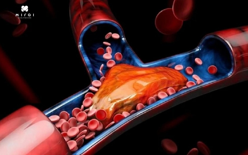 Kết quả APL (+) cảnh báo nguy cơ cao hình thành cục máu đông