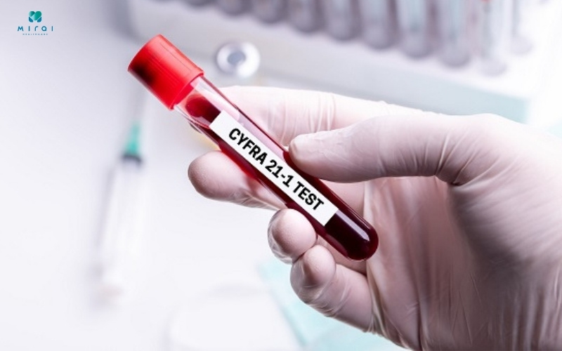 Xét nghiệm Cyfra 21-1 phát hiện ung thư phổi giai đoạn sớm