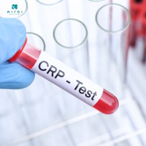 Xét nghiệm CRP không yêu cầu nhịn ăn