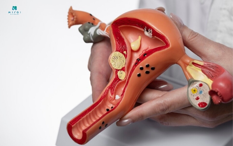 HIV có thể gây ung thư cổ tử cung ở nữ