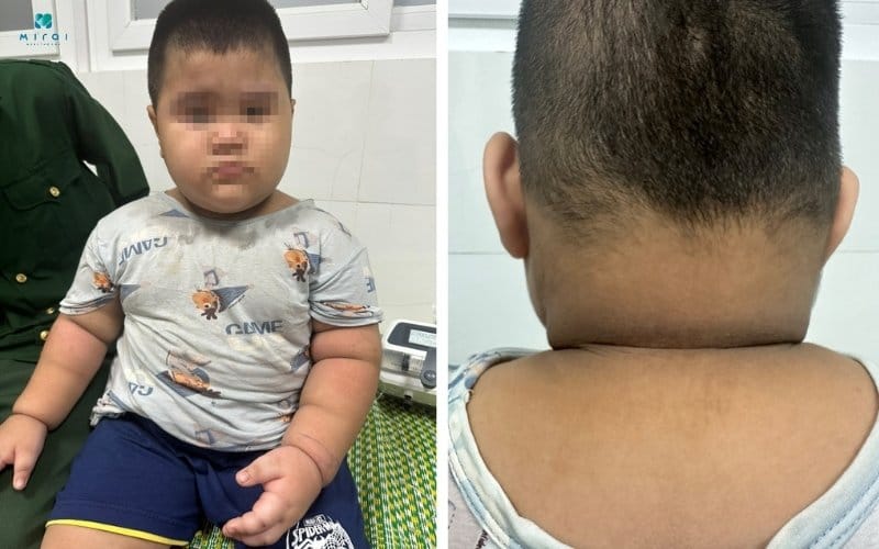 Xét nghiệm ACTH giúp chẩn đoán bệnh Cushing