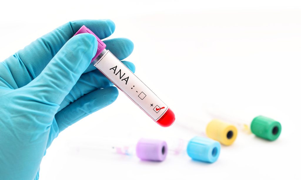 Xét nghiệm ANA phát hiện các kháng thể kháng nhân trong máu