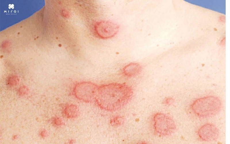 ANA dương tính cho thấy bạn bị Lupus