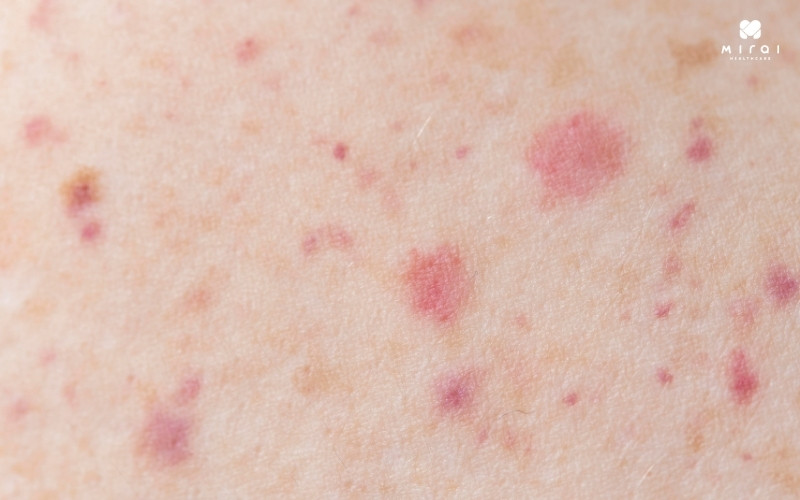 Xét nghiệm NS1 chẩn đoán sớm sốt xuất huyết