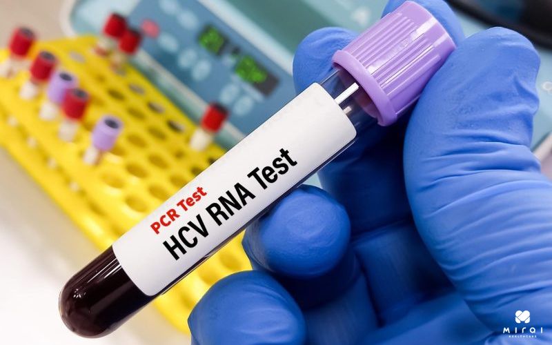 Xét nghiệm HCV-RNA là cần thiết để xác định viêm gan C