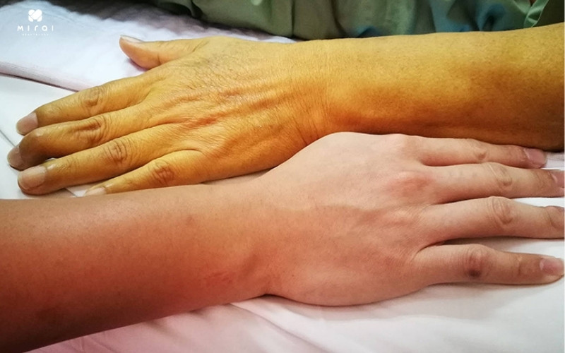 Khi có dấu hiệu vàng da bạn nên đi xét nghiệm viêm gan sớm