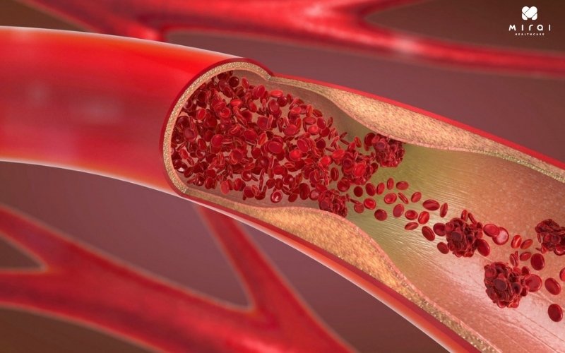 Xét nghiệm Anti Cardiolipin giúp chẩn đoán bệnh đông máu