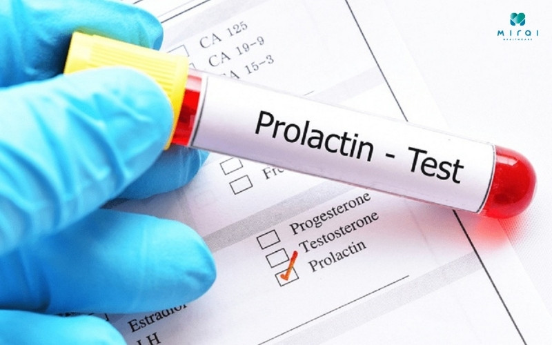 Prolactin là một chỉ số xét nghiệm nội tiết tố nam quan trọng