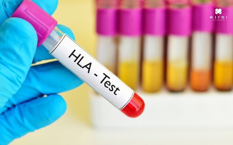 Xét nghiệm HLA-B27 để chẩn đoán bệnh viêm và tự miễn khác