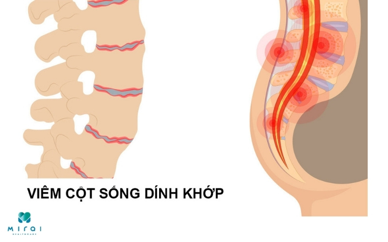 Xét nghiệm HLA-B27 hỗ trợ bệnh viêm cột sống dính khớp