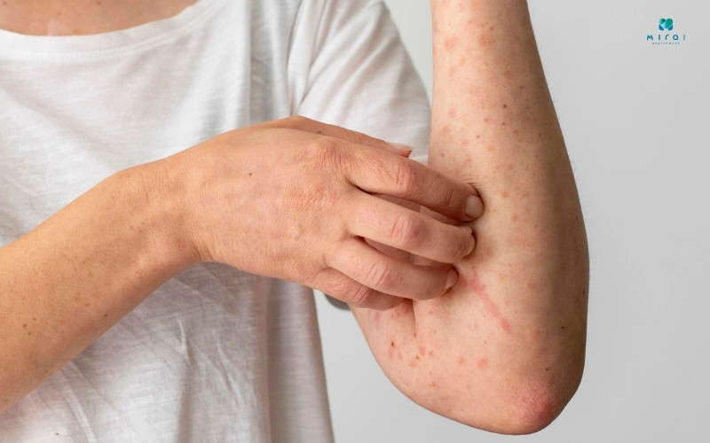 Sốt xuất huyết gây phát ban ở mặt, ngực rồi lan khắp người