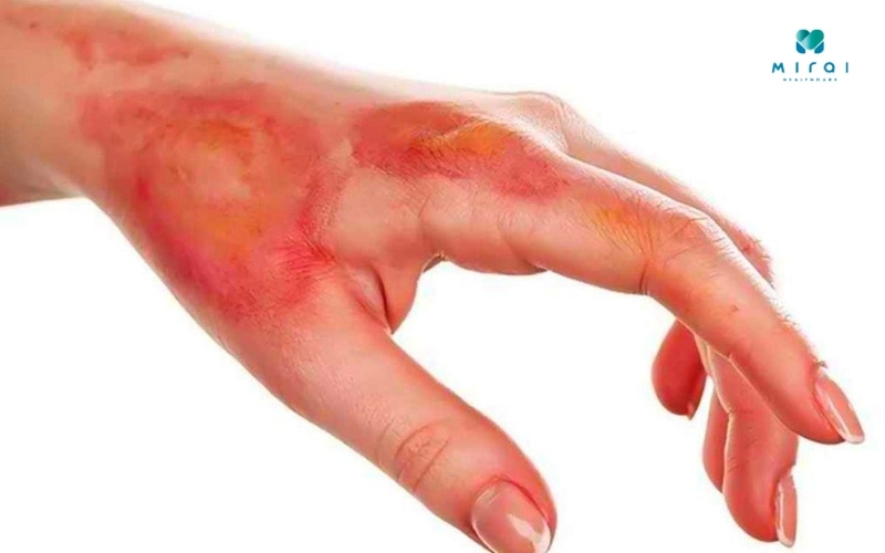 Khi bị bỏng diện rộng cũng có thể khiến chỉ số PCT tăng 