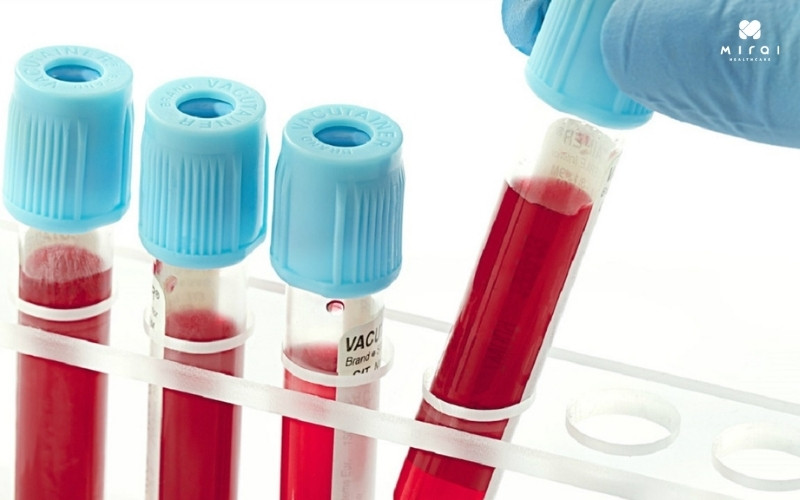 Xét nghiệm PLT xác định số lượng tiểu cầu trong huyết tương