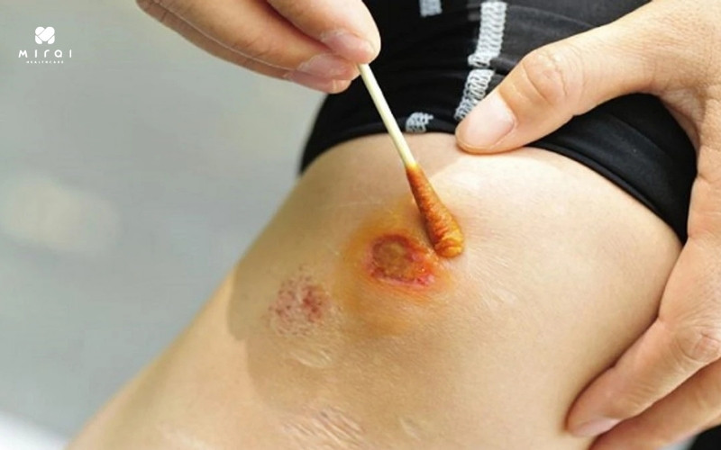 Xét nghiệm WBC khi nghi ngờ nhiễm trùng