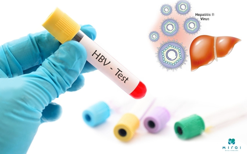 Xét nghiệm viêm gan HBV phát hiện ung thư gan giai đoạn sớm