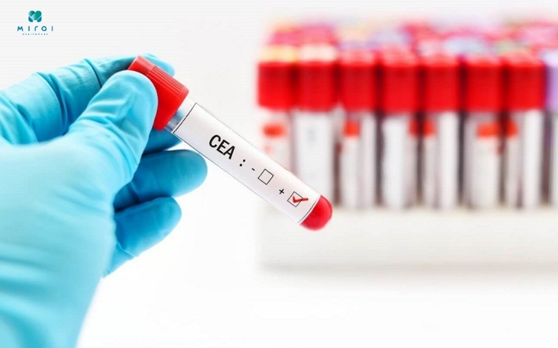 Chỉ số CEA giúp để theo dõi điều trị bệnh ung thư vú