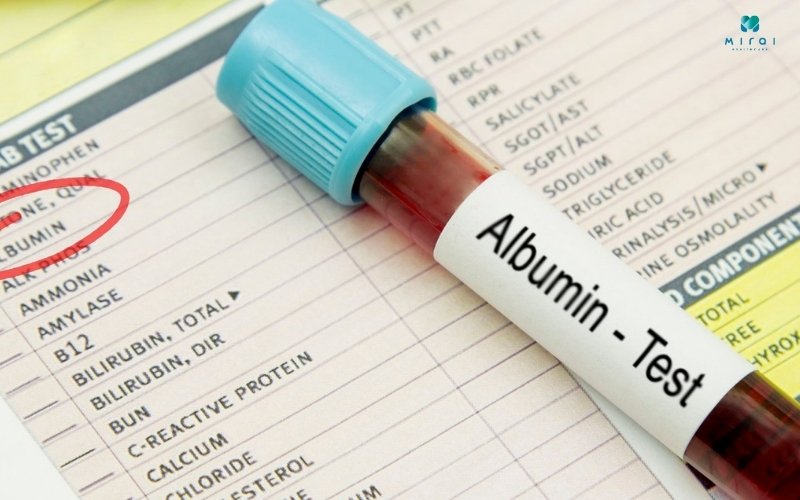 Albumin giảm cho thấy chức năng của thận cũng suy giảm