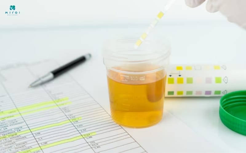 Xét nghiệm creatinin niệu là đo nồng độ chất trong nước tiểu