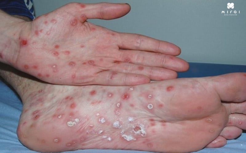 Phát hiện sớm giang mai giúp tăng khả năng chữa khỏi