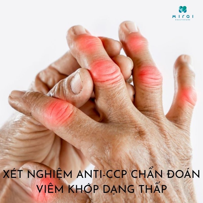 xet-nghiem-anti-ccp-chan-doan-benh-viem-khop-dang-thap