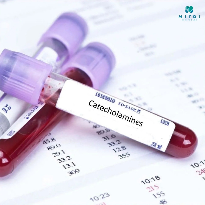xet-nghiem-catecholamin-mau-chan-doan-u-tuy-thuong-than