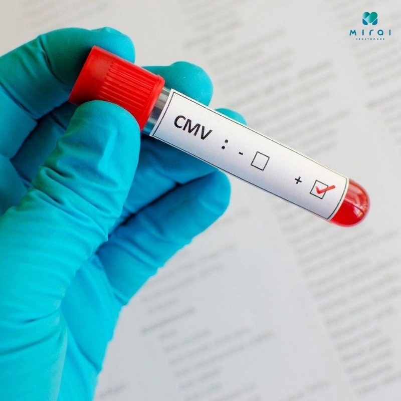 xet-nghiem-cmv-mau-xac-dinh-ton-tai-virus-cytomegalovirus
