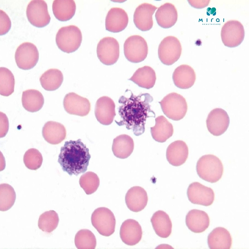 xet-nghiem-hong-cau-luoi-giup-chan-doan-cac-benh-ly-lien-quan