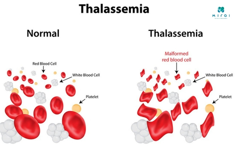 xet-nghiem-thalassemia-giup-phat-hien-dot-bien-gen