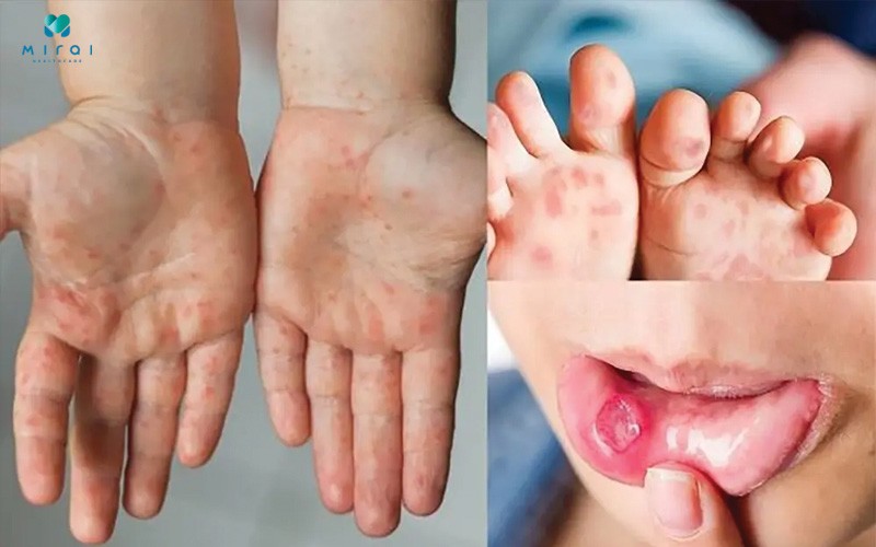 Bệnh tay chân miệng đang gia tăng thời gian gần đây